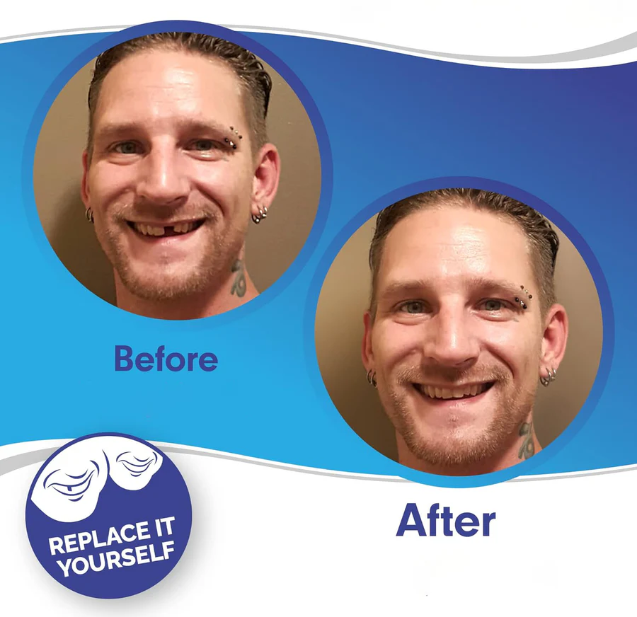Clip On Veneer with Adjustable Silicone Strip and Storage Case